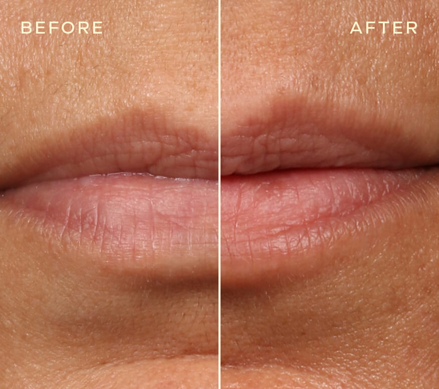 Replenishing Lip Filler